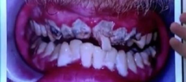 Os dentes de Jay antes das cirurgias Os dentes de Jay antes das cirurgias