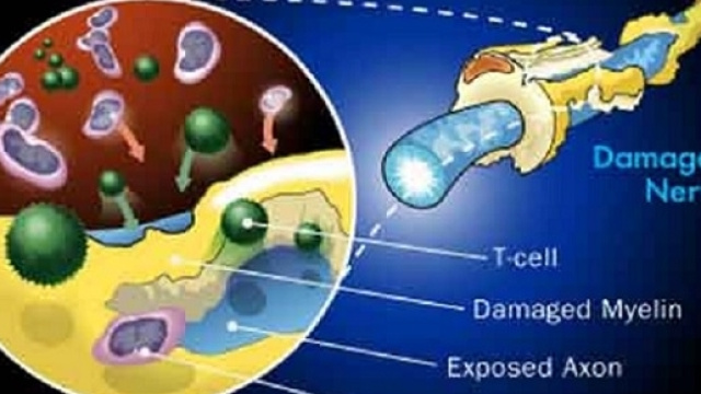 La flora intestinale controlla il nostro sistema immunitario e pu&ograve; avere un ruolo importante nella sclerosi multipla.