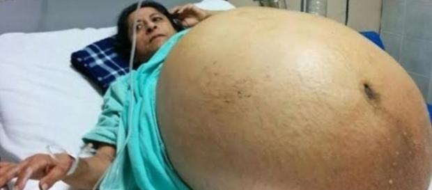 O tamanho do tumor impressionou os médicos ( Foto - Reprodução ) O tamanho do tumor impressionou os médicos ( Foto - Reprodução )