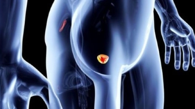 Caffé e tumore alla prostata: il legame è racchiuso in 3 tazzine ... - velvetbody.it