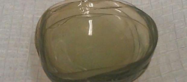 Mulher britânica teve 27 lentes de contato removidas de seu olho, e 17 delas estavam grudadas uma em cima da outra Mulher britânica teve 27 lentes de contato removidas de seu olho, e 17 delas estavam grudadas uma em cima da outra