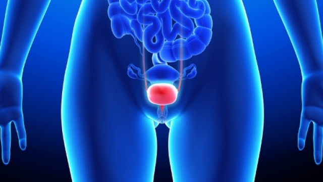 Tumori alla vescica causati dalle sigarette