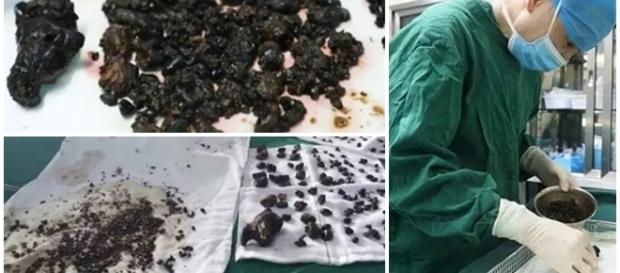 Mulher passar por cirurgia para remoção de pedras Mulher passar por cirurgia para remoção de pedras