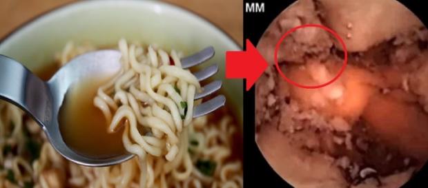 Miojo não cai tão bem assim no estômago (Foto: Reprodução/ Montagem) Miojo não cai tão bem assim no estômago (Foto: Reprodução/ Montagem)