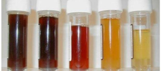Impariamo a interpretare le urine - Global-Liputan Impariamo a interpretare le urine - Global-Liputan