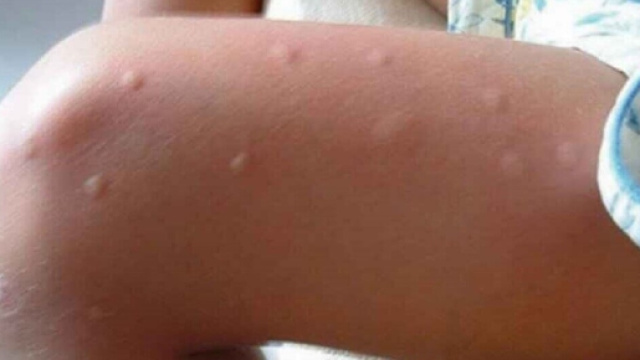 Pensi che le zanzare pungano pi&ugrave; te che gli altri? Allora devi ... - mondoincredibile.com