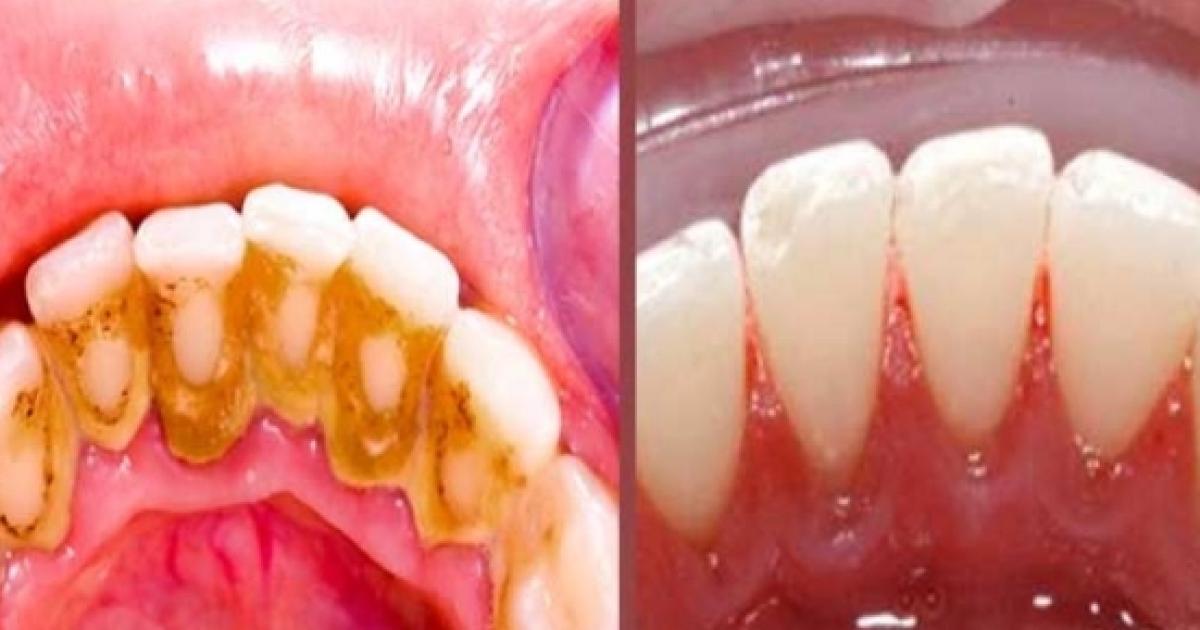 Como remover tártaros dos dentes em minutos