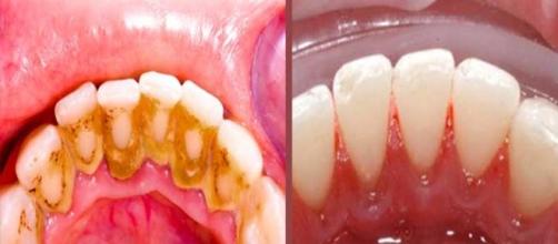 Tártaro é o acúmulo de bactérias nos dentes
