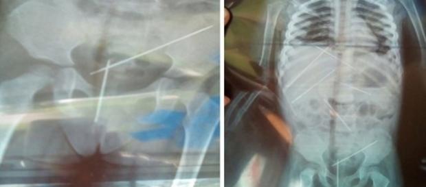 Criança morre após ter agulhas inseridas no corpo Criança morre após ter agulhas inseridas no corpo