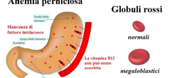 Sono necessarie nuove linee guida su diagnosi precoce e terapie nell’anemia perniciosa.