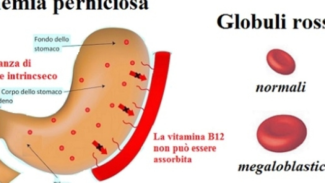 Sono necessarie nuove linee guida su diagnosi precoce e terapie nell&rsquo;anemia perniciosa.