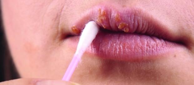 Sexo oral transmite supergonorreia e outras doenças (Foto: Reprodução) Sexo oral transmite supergonorreia e outras doenças (Foto: Reprodução)