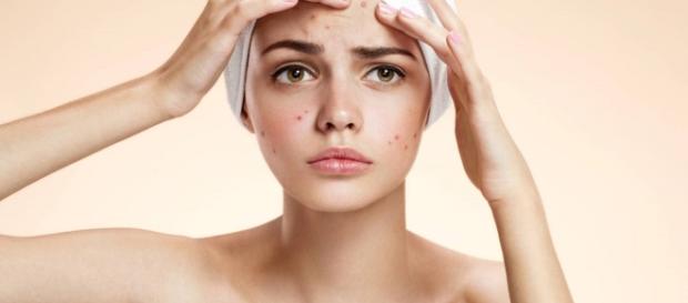 Acne e brufoli ko con 3 semplici trattamenti a base di sale - foto:inran Acne e brufoli ko con 3 semplici trattamenti a base di sale - foto:inran