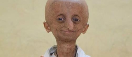 Progeria se caracteriza pelo envelhecimento precoce - Google