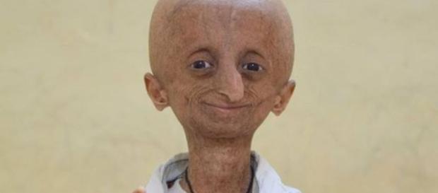 Progeria se caracteriza pelo envelhecimento precoce - Google Progeria se caracteriza pelo envelhecimento precoce - Google