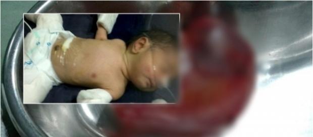 Bebê é operado para tirar irmão parasita Bebê é operado para tirar irmão parasita