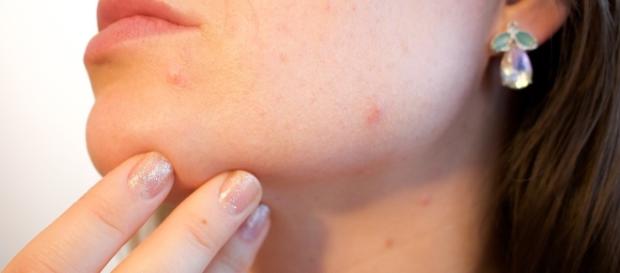 Free photo: Acne, Pores, Skin, Pimple, Female - Free Image on ... - pixabay.com Free photo: Acne, Pores, Skin, Pimple, Female - Free Image on ... - pixabay.com