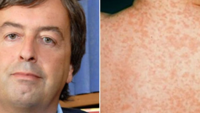 Morbillo veicolatore della panencefalite sclerosante subacuta.