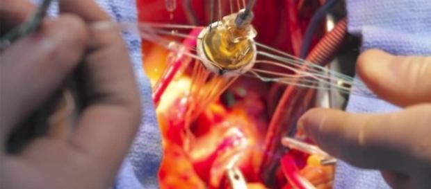 Herzchirurgie - Operation.net - operation.net Herzchirurgie - Operation.net - operation.net