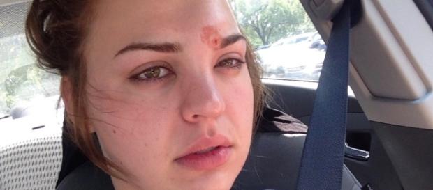 Katie Wright contraiu uma celulite infecciosa (Foto: Reprodução/Twitter) Katie Wright contraiu uma celulite infecciosa (Foto: Reprodução/Twitter)