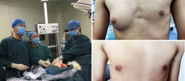 Unui adolescent i-a crescut un singur sân de cupă A iar explicația e șocantă - Foto: AsiaWire Unui adolescent i-a crescut un singur sân de cupă A iar explicația e șocantă - Foto: AsiaWire