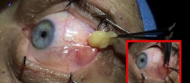 Vídeo mostra como é feito a cirurgia de remoção de cisto ocular Vídeo mostra como é feito a cirurgia de remoção de cisto ocular