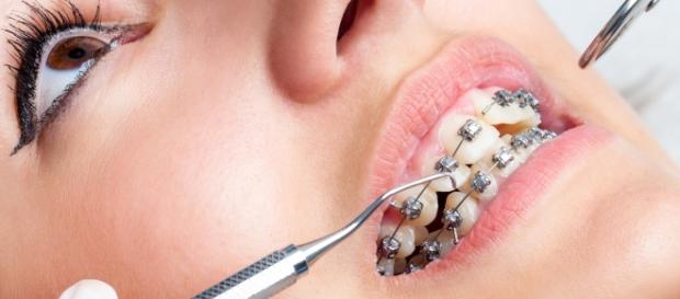La Ortodoncia mejora la posición dental. - clasor.com La Ortodoncia mejora la posición dental. - clasor.com