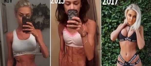 Annalise quase morreu por conta da anorexia, mas conseguiu se recuperar e voltar a ser saudável Annalise quase morreu por conta da anorexia, mas conseguiu se recuperar e voltar a ser saudável