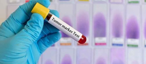 Nuovo test del sangue scova tumori