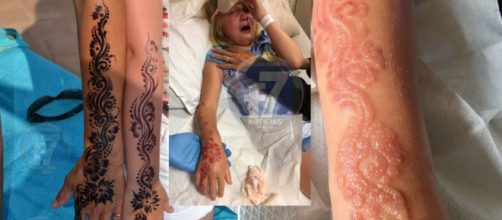 Caso da menina que teve braço destruído por causa de tatuagem de henna ganha destaque nacional