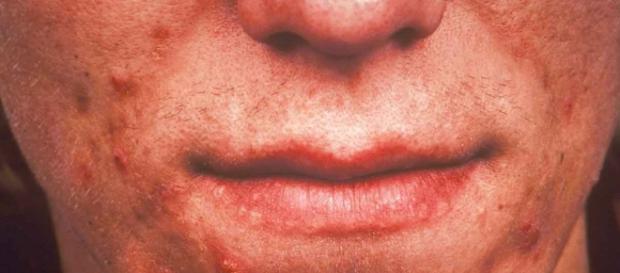 Bactéria da acne pode causar infecções e câncer Bactéria da acne pode causar infecções e câncer