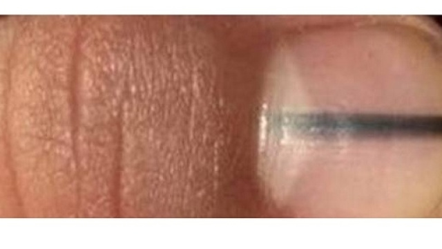 Aveva una riga nera sotto l'unghia, scopre di avere un melanoma