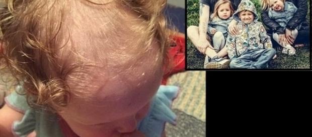 Depois de várias tentativas frustradas, a mãe decidiu raspar a cabeça da menina que sofre com doença Depois de várias tentativas frustradas, a mãe decidiu raspar a cabeça da menina que sofre com doença