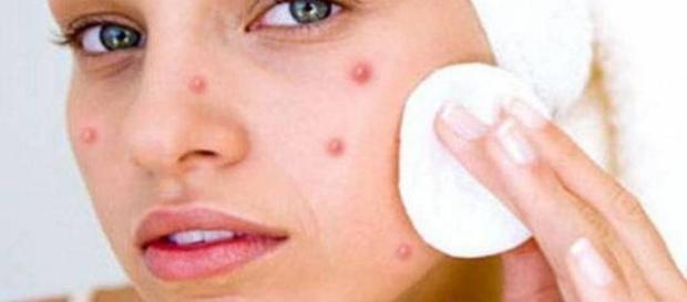 Existen diferentes tipos de acné en el rostro. - sumedico.com Existen diferentes tipos de acné en el rostro. - sumedico.com