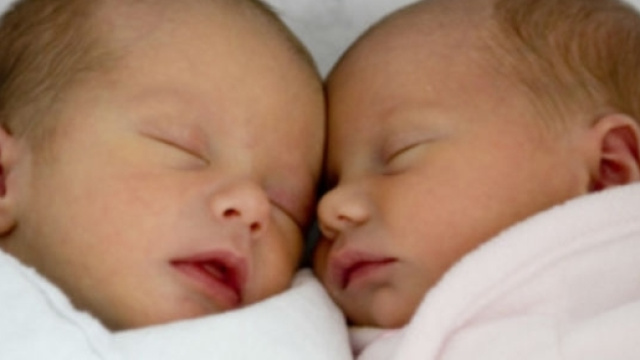 Gemelli siamesi (foto d'archivio)