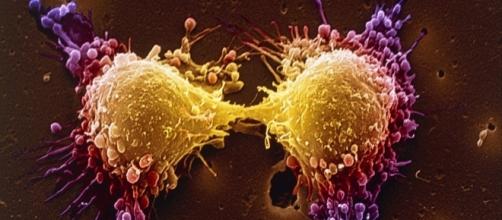 Tumor típico del cáncer de próstata. Fotografía del Wall Street Journal