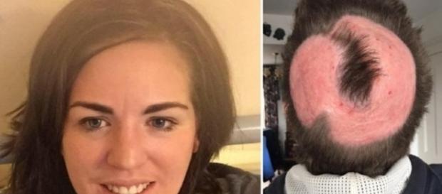 Mulher deseja ter cabelo da moda e queima toda a cabeça Mulher deseja ter cabelo da moda e queima toda a cabeça