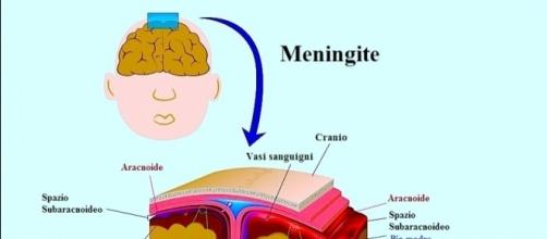 Sintomi della meningite virale e batterica,cause e terapia - fisioterapiarubiera.com
