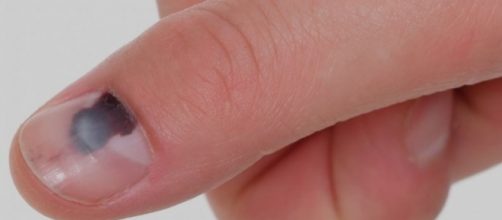 O que podem nos dizer as manchas escuras sob as unhas? (Foto internet)