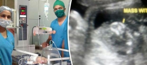 Bebê nasceu 'grávido' na Índia Bebê nasceu 'grávido' na Índia
