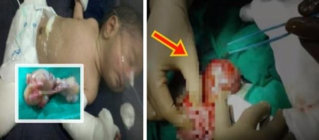 Bebê nasce grávido do irmão, na Índia Bebê nasce grávido do irmão, na Índia