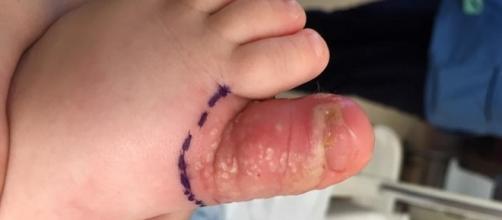 Criança ficou com inflamação no dedo do pé
