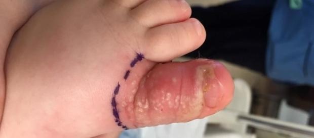 Criança ficou com inflamação no dedo do pé Criança ficou com inflamação no dedo do pé