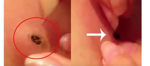 Procure a ajuda de um especialista para remover cravos e espinhas de sua pele ( Fotos - Youtube )
