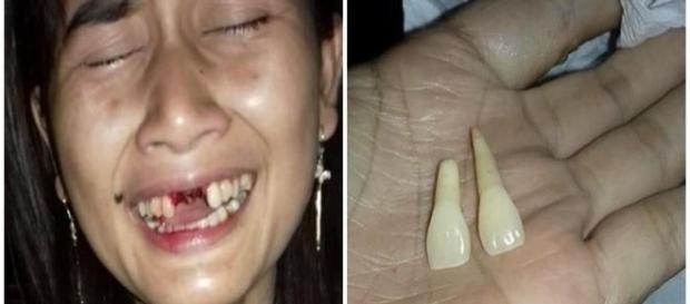 Mulher é agredida pelo próprio marido e perde dois dentes. Mulher é agredida pelo próprio marido e perde dois dentes.