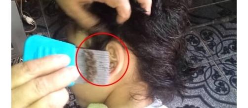 A quantidade de piolhos no cabelo dessa garotinha é inacreditável ( Foto - Youtube )