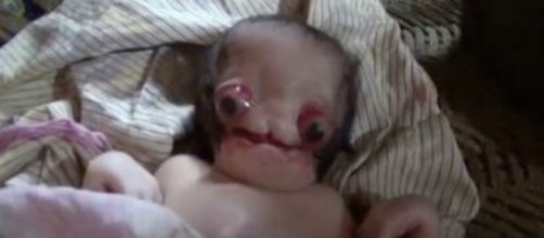 Il bambino nato senza bocca, naso e orecchie