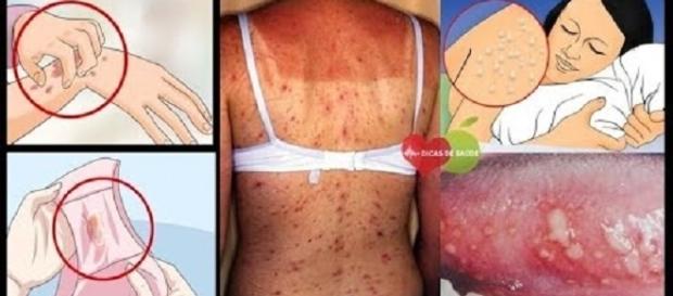 Alguns dos sintomas do HIV incluem erupções na pele Alguns dos sintomas do HIV incluem erupções na pele