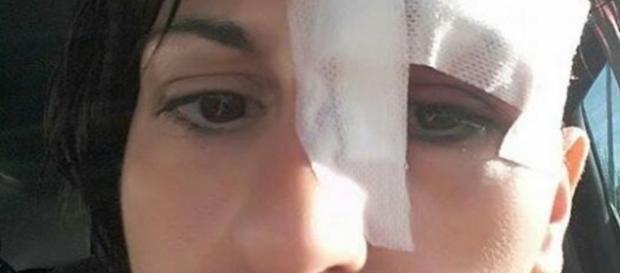 Le ferite riportate da Veronica Nigro: la donna è caduta per evitare un topo Le ferite riportate da Veronica Nigro: la donna è caduta per evitare un topo