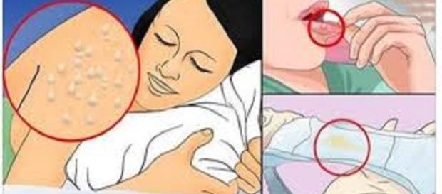 Sintomas típicos do vírus HIVno organismo Sintomas típicos do vírus HIVno organismo